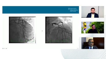 Stable Coronary Artery Disease