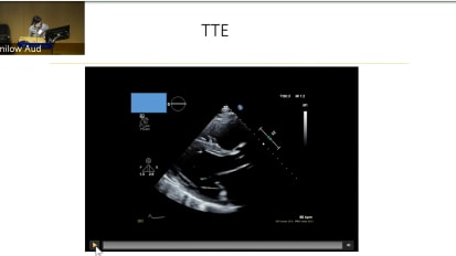 Percutaneous Axial Flow Pumps and Their Role in Advanced Cardiogenic Shock