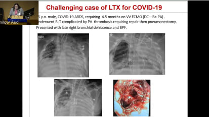 Prolonged ECMO Support in COVID ARDS When and Who Should be Considered for Lung Transplant