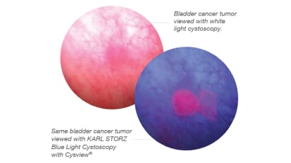 Blue Light Cystoscopy Clinical Advantages