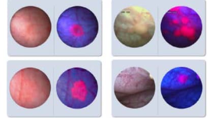 Value Analysis Brief KARL STORZ Blue Light Cystoscopy with Cysview® (BLCC) System*