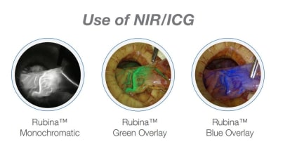 Fluorescence Imaging in Colorectal Surgery