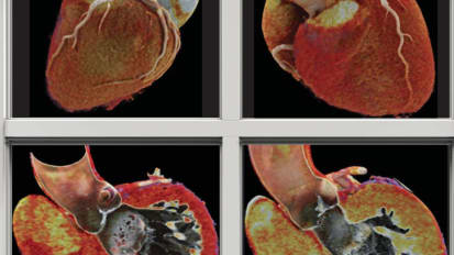 Windows to the Heart: Safer Faster CT Technology Produces Images that Give New Clinical Insights into Coronary Artery Disease