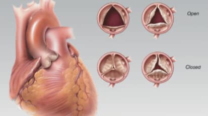 Transcatheter Aortic Valve Replacement (TAVR) at John Muir Health: Fulfilling an Unmet Need for Treating Patients at Intermediate and Severe Surgical Risk for Aortic Stenosis