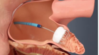 MUSC Health Offers Stroke-Reducing Device as Warfarin Alternative