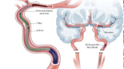 A Pioneering New Technique for Mechanical Thrombectomy 