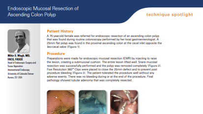 EMR of Ascending Colon Polyp Presented by Mihir Wagh, MD, FACG, FASGE