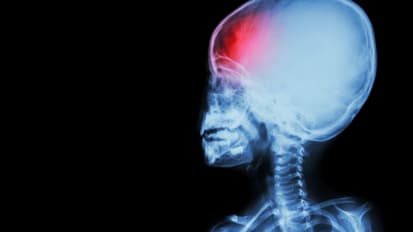 Pediatric Stroke and Cerebrovascular Disease