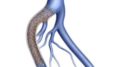Knowledge Check: Introductory Venovo™ Venous Stent System Training