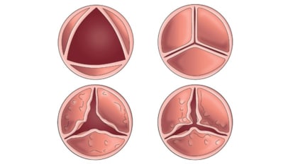 Benefit shown in off-label use of catheter aortic-valve repair