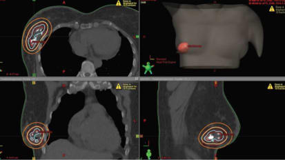 Physician News: Developments in Brachytherapy Aid Cancer Treatment