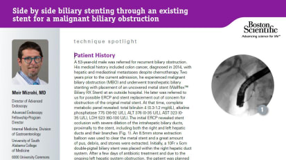 Utility of Side-by-Side 6Fr Biliary Metal Stent Placement for a Malignant Biliary Obstruction, Meir Mizrahi, MD