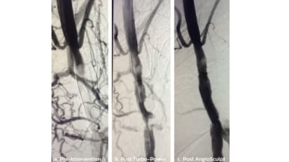 Mathews - Successful treatment of a calcified CTO