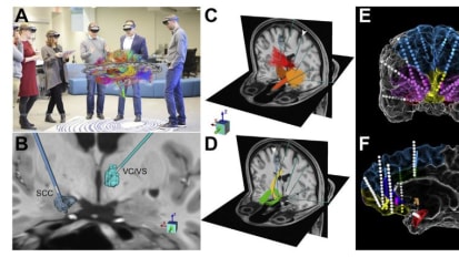 Deep Brain Stimulation for Depression Informed by Intracranial Recordings