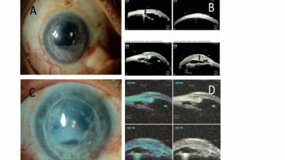 Eye Plaque Radiation Therapy Preserves the Sight of Patients With Invasive Carcinoma