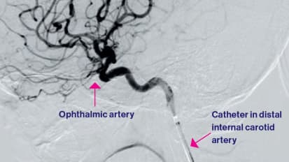 NYEE-Mount Sinai Eye Stroke Protocol Saves a Young Woman’s Sight