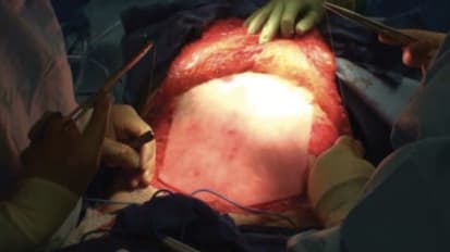 Clinical Use of GORE<sup>®</sup> BIO-A<sup>®</sup> Tissue Reinforcement in Ventral Hernia Repair Using the Components Separation Technique