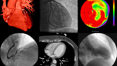 Intravascular Ultrasound (IVUS) in Hemodialysis Access