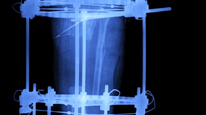 Pediatric Limb Lengthening and Complex Reconstruction