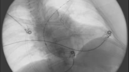 IVUS Use in AV Access