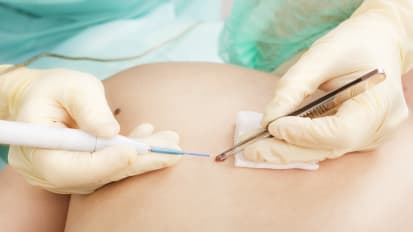 Recent Advances in Surgery for Melanoma