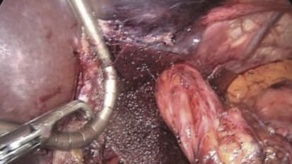 Tissue Reinforcement with GORE<sup>®</sup> BIO-A<sup>®</sup> Material in Large Hiatal Hernias: A Prospective Clinical Study