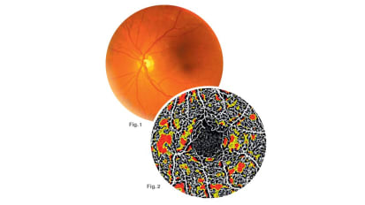 New Retinal Capillary Density Mapping Technique Could Provide an Advanced Window on Disease