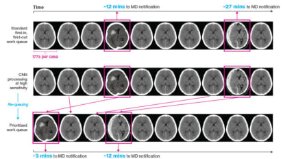 Study Shows How Artificial Intelligence Helped Detect Acute Neurological Cases Earlier