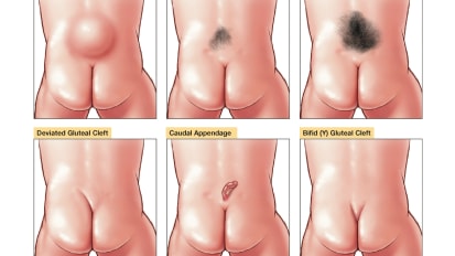 Markers of Spinal Dysraphism