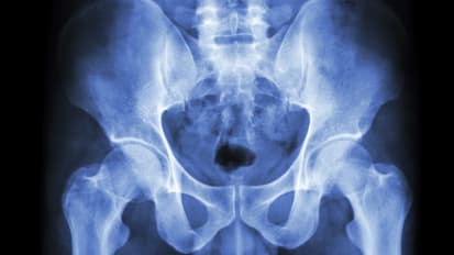 Initial Management of Major Pelvic Fractures