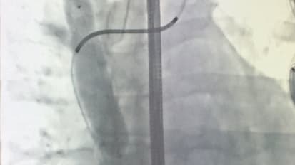 Philips Bridge Occlusion Balloon Best Practices Protocol