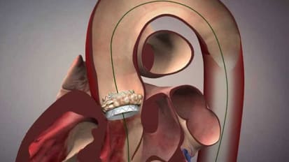 Device test may determine near future of aortic-valve repair