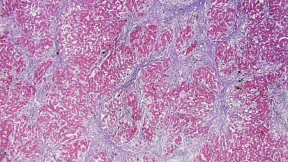 Copper Deficiency in Liver Diseases: A Case Series and Pathophysiological Considerations