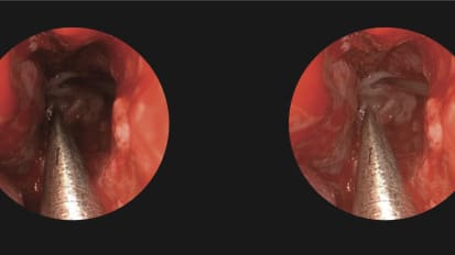 Expanded endonasal for resection of complex skull base tumor