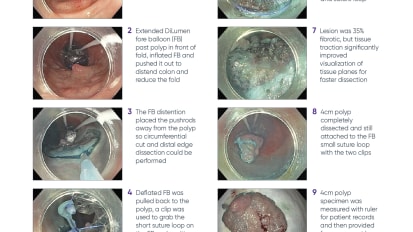 En Bloc ESD Removal of Rectosigmoid Polyp using DiLumen®