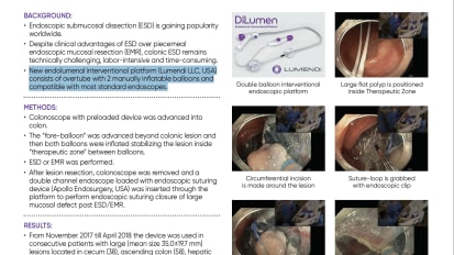 Clinical Experience with DiLumen® in Endoscopic Submucosal Dissection (ESD)