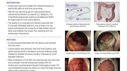 Endoscopic Submucosal Dissection for Removal of Large Colorectal Lesions: Initial Experience With a New Therapeutic Platform