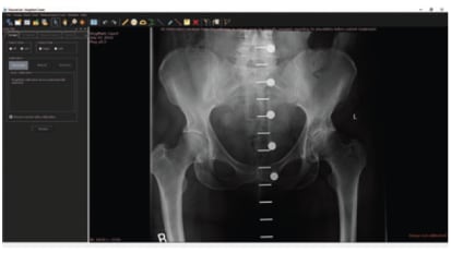 RI.HIP NAVIGATION: Lateral Position Surgical Technique