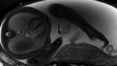 Prenatal Radiographic Evaluation of Congenital Transverse Limb Deficiencies