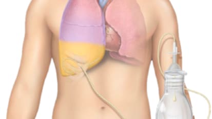 PeritX™ Peritoneal Catheter System and PleurX™ Pleural Catheter System Home Health In-Servicing Presentation