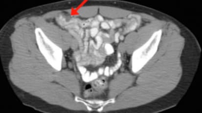 EUS of a submucosal lesion at the appendiceal orifice using a double-balloon endoluminal intervention platform