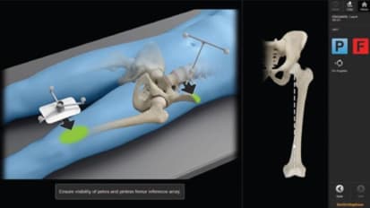 RI.HIP NAVIGATION: Supine Position Surgical Technique