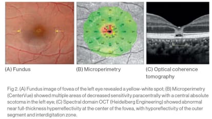 An Unprecedented Look at Acute Solar Retinopathy