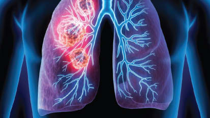 Temple Healthy Chest Initiative: a New Approach to Lung Cancer Screening