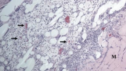 Biosynthetic Tissue Scaffold Recruits Progenitor Cells in Muscle Tissue Healing Model