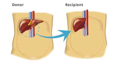 Adult-to-Adult Living Donor Liver Transplantation