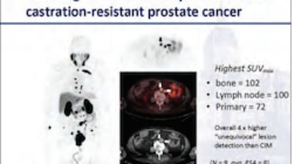 Breakthrough in Prostate Cancer Imaging