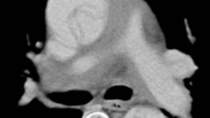 The Aorta in 3-D: More Clarity and Accuracy