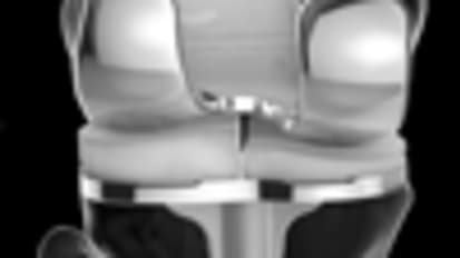 ConforMIS Demonstrates Excellent Outcomes with Patient-Specific Knee Total Knee Implants