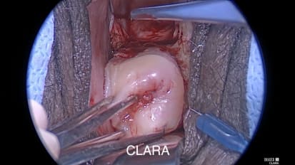 NEW Vaginal Hysterectomy Approach Using the VITOM® Exoscope with IMAGE1 S